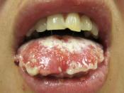 English: Mucosal desquamation in a person with Stevens–Johnson syndrome