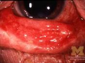 Stevens-Johnson Syndrome affecting the eye