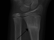 English: A buckle fracture of the radial metaphysis
