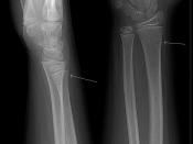 English: X-ray of a greenstick fracture of a wrist. Nederlands: Röntgenfoto van een greenstickfraktuur van de pols. Deutsch: Wulstbruch des Radius