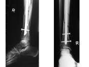 X-ray showing the distal portion of a fractured tibia and intramedular nail.