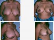 English: Breast reduction: pre-operative and post-operative views; front and three-quarter views respectively.