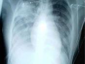 A chest x-ray showing increased opacity in both lungs, indicative of pneumonia, in a patient with SARS.