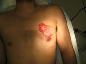 A large glandular mass of male breast tissue, surgically removed