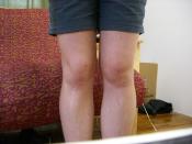 My Swollen Knee