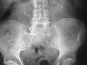 Bilateral kidney stones on abdominal X-ray. Not to be confused with phleboliths seen in the pelvis.