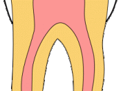 An animation showing the progress of pit and fissure caries (tooth decay).
