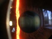 Slit lamp image of the cornea, iris and lens