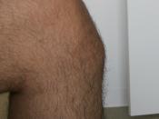 English: 25 year old male with Osgood-Schlatter disease.