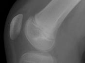 English: X-ray of a knee with Osgood-Schlatter Nederlands: Röntgenfoto van een knie met Osgood-Schlatter
