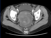 English: An ovarian cancer as seen on CT