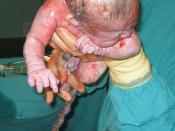 Newborn child, soon after birth by Caesarian section.