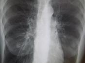 English: A chest X-ray demonstrating severe COPD. Note the small size of the heart in comparison to the lungs.