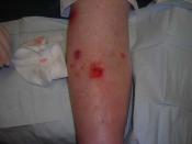 English: A 63-year-old female with diabetes and rheumatoid arthritis presented with a chronic venous ulceration (2 cm X 2.6 cm) to the dorsal aspect of the right leg. The wound had been present for over two months despite application of compression therap