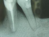 English: Periodontal bone loss shown in X-Ray image.