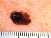 Title: Pathology: Patient: Melanoma: Asymmetry Description: Part of the ABCDs for detection of melanoma. See artwork: WYNTK-15b. Topics/Categories: Pathology -- Patient Type: Color Slide Source: Skin Cancer Foundation Author: Unknown photographer/artist A