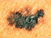 Title: Pathology: Patient: Melanoma: Color Description: Seen is melanoma, with coloring of different shades of brown, black, or tan. Part of the ABCDs for detection of melanoma. See artwork: WYNTK-15b. Topics/Categories: Pathology -- Patient Type: Color S