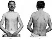 Deutsch: Ein Bild aus Johannes Fabrys Artikel Zur Klinik und Ätiologie des Angiokeratoma. Es zeigt den Patienten Emil Honke 1915 im Alter von 30 Jahren.