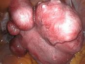 Uterine fibroids Latina: Uterus myomatosus