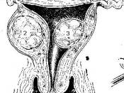 Uterine fibroids Picture