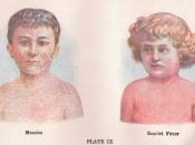 English: Illustrations of children with Measles and Scarlet Fever Français : Exanthème dans la rougeole et la scarlatine.