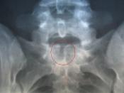 English: X ray image of a pelvis of a 16 year old female with Spina Bifida occulta in S-1.