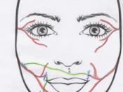 English: Image of the babysitter procedure in facial paralysis.