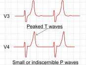 English: Electrocardiography showing precordial leads in hyperkalemia. Image was made in Inkscape, drawing lines as averages between ECGs on the following pages: Coexisting Disease & Adult Cardiac Surgical Procedures: Anesthesia Implications, image by Fra