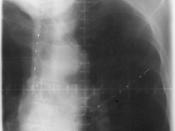 Endobronchial radiation therapy for non-small cell lung cancer. AP view