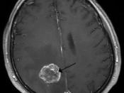Deutsch: MRT einer Hirnmetatase eines Bronchialkarzinoms (T1 nach Kontrastmittelgabe)