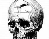 Skull diagram of Phineas Gage