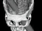 CGI image of rod piercing Phineas Gage's skull taken from NINDS public domain page at http://www.ninds.nih.gov/health_and_medical/pubs/tbi.htm