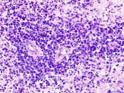 CNS lymphoma (1) B-cell type
