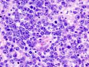 CNS lymphoma (2) B-cell type