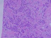 English: Invasive ductal carcinoma of breast