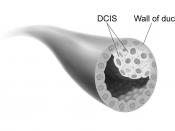 Shown is a drawing of a breast duct containing ductal carcinoma in situ.